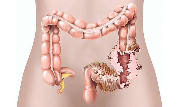 Дивертикулез