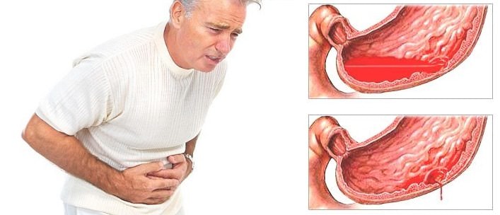 Перфорация язвы